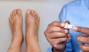 Serious signs on feet indicate diabetes