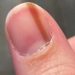 Woman suffers from strange line under her fingernail 18 Woman suffers from strange line under her fingernail