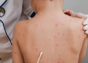 الاحتلال يعلن اكتشاف أول إصابة بمرض جدري "القردة"