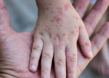 اجتماعاً طارئاً تعقده الصحة العالمية  لبحث تفشي مرض “جدري القردة”