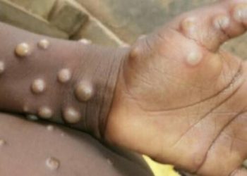 WHO warns of major outbreak of “monkeypox”