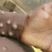 WHO warns of major outbreak of “monkeypox” 15 WHO warns of major outbreak of “monkeypox”