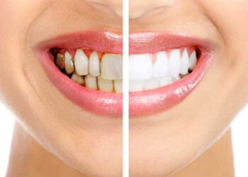 دراسة.. إهمال تنظيف الأسنان قد يسبب الجلطات والخرف