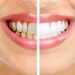 دراسة.. إهمال تنظيف الأسنان قد يسبب الجلطات والخرف 97 دراسة.. إهمال تنظيف الأسنان قد يسبب الجلطات والخرف