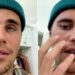 What is Ramsay Hunt Syndrome that affects Justin Bieber? 17 What is Ramsay Hunt Syndrome that affects Justin Bieber?
