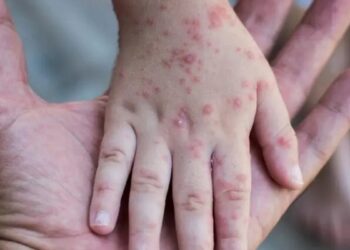 أكثر من 5 آلاف إصابة مؤكدة بجدري القردة في العالم