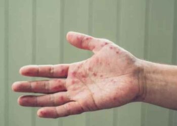 دراسة ألمانية: عدوى جدري القرود قد تنتقل عبر ملامسة الأسطح!