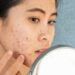 New treatment for acne 17 New treatment for acne