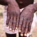 WHO declares monkeypox "global emergency"