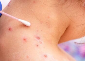 جدري القرود