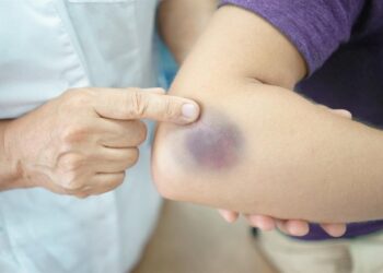 Difference between bruises types, do it indicates blood problems?