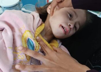 أونروا تحذّر من معاناة الأطفال في غزة بسبب سوء التغذية الحاد